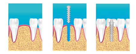 implants dentaires paris 20